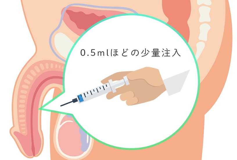 海綿體注射治療勃起功能障礙的醫療程式說明
